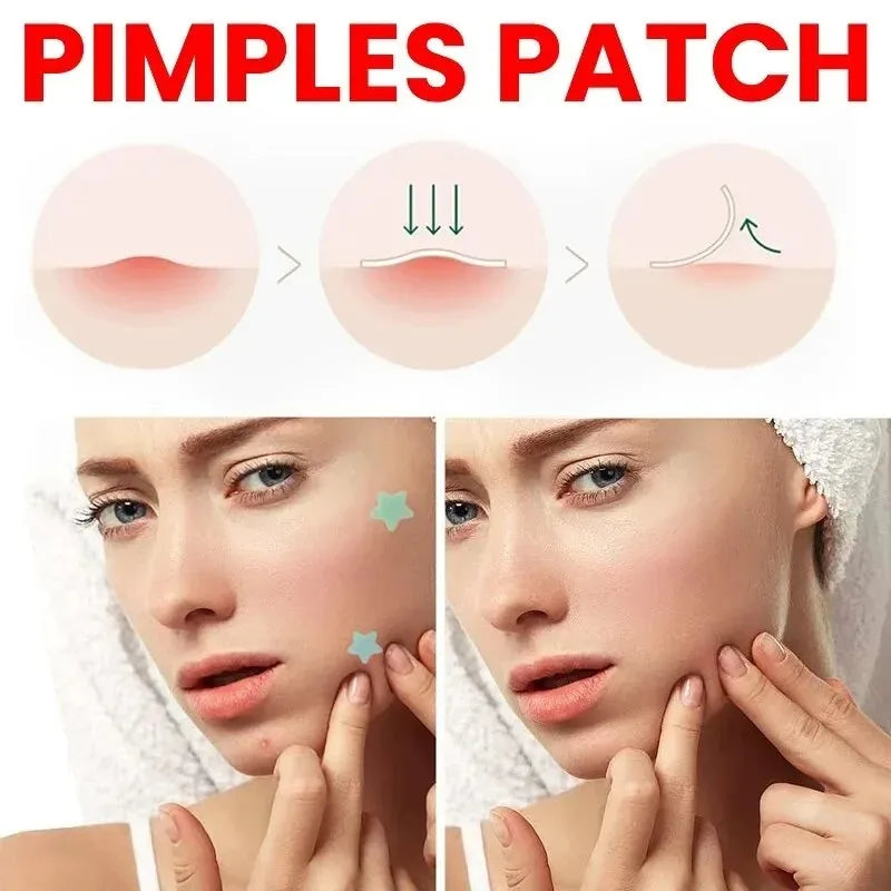 200pcs Repair Acne Patch Facial Skin Care Fade Blemishes Pimple Marks